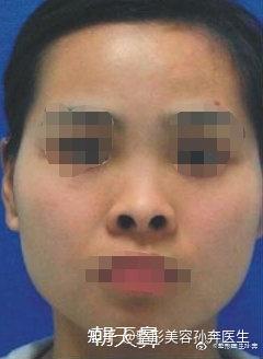 为什么有些人会出现天生鼻型类似 猪鼻子 情况 鼻孔大且朝天 知乎