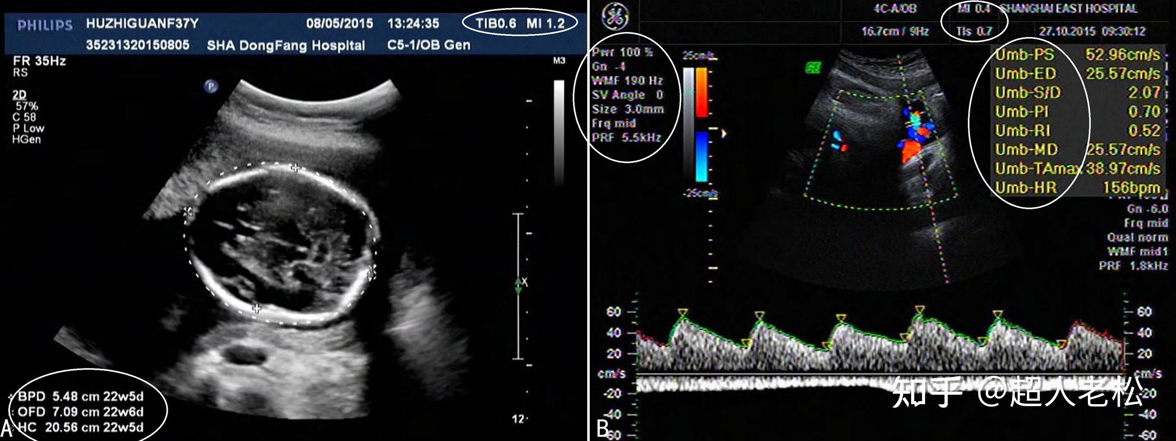 多普勒检查仪器显示仪器可以显示血流速度,脉冲重复频率,多普勒超声