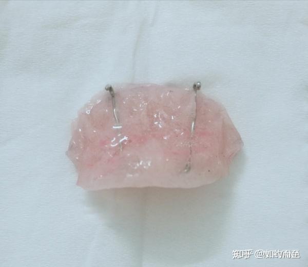 1,牙齿带上牙套的最初的情况:后牙的大牙被垫高,也就是带了颌垫,大牙