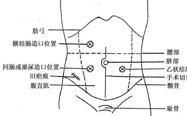 乙状结肠造口位置图片