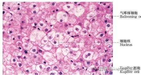 肝脏常见病理变化
