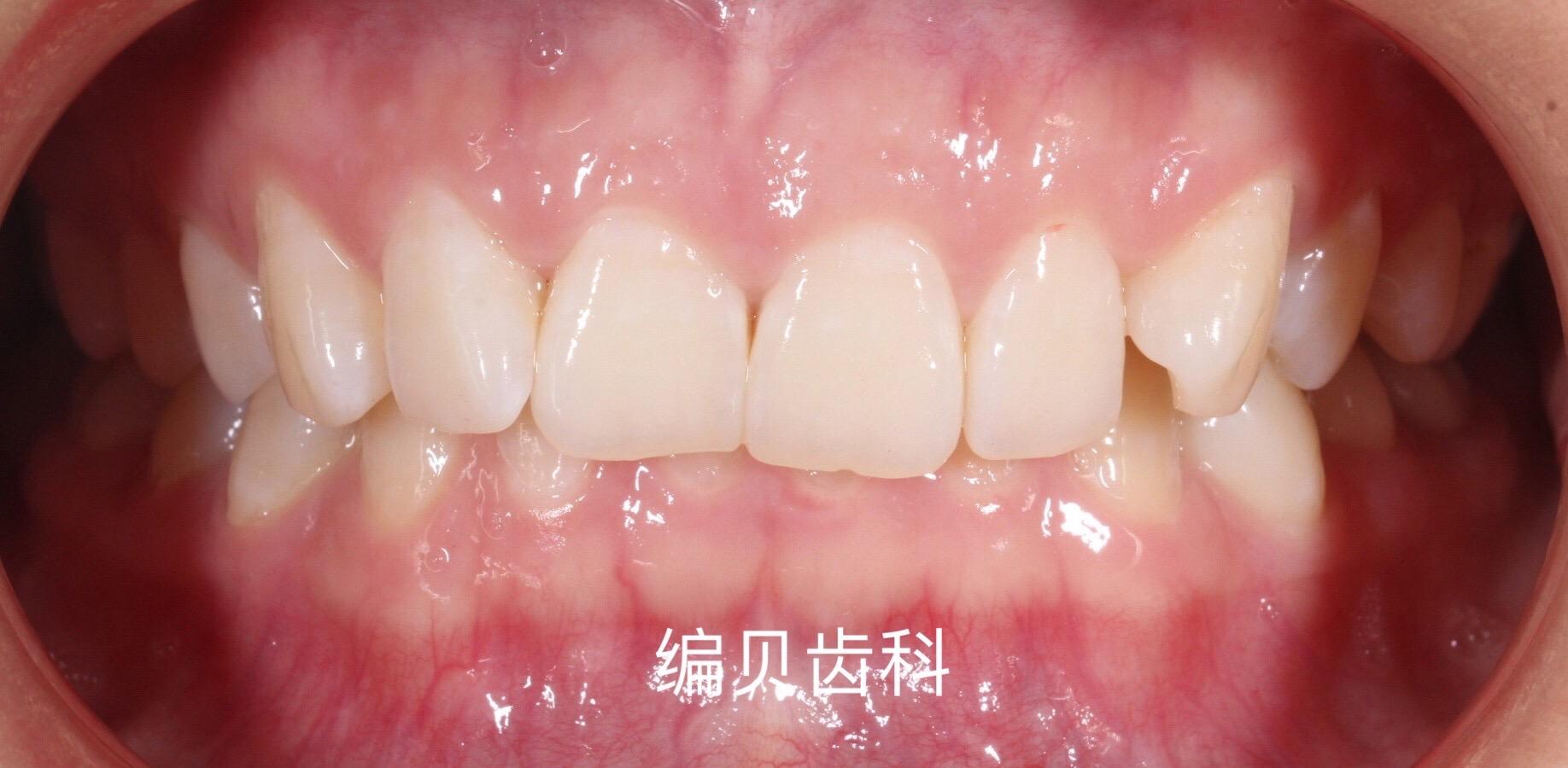 郑州时代天使矫治内倾性深覆合案例分享