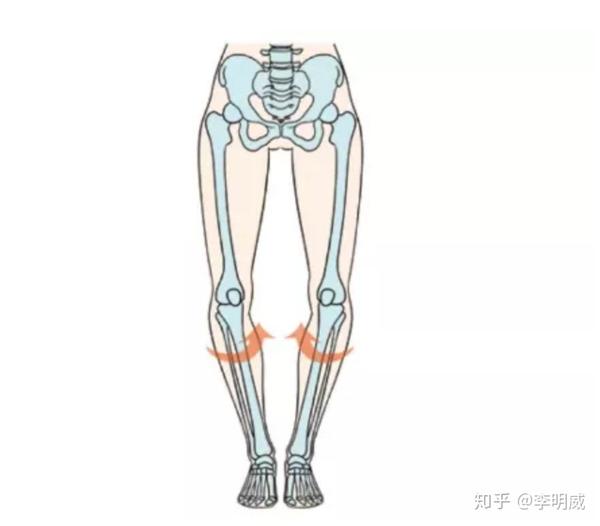 "o型腿"除了腿形不好看之外,这些问题更应该引起重视!