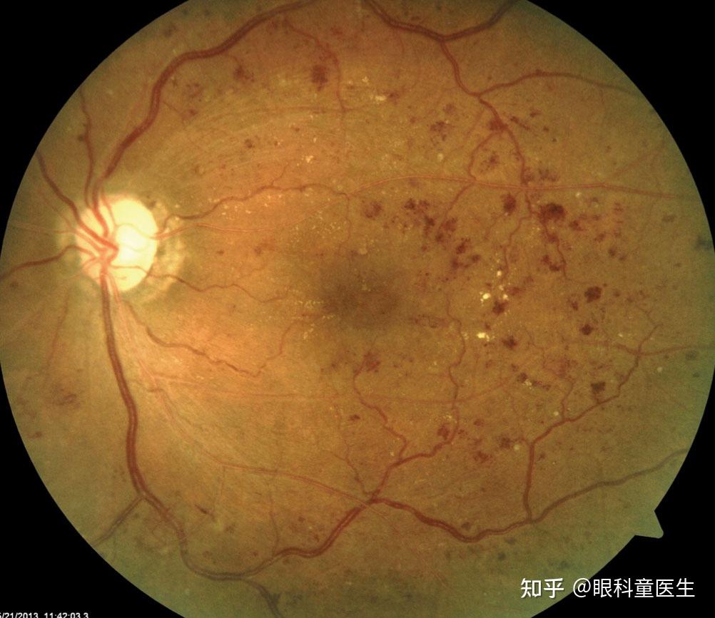 视网膜血管性疾病1视网膜静脉阻塞
