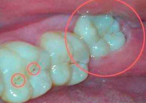 为什么牙医说我的智齿要分开几次拔不能一次性拔完