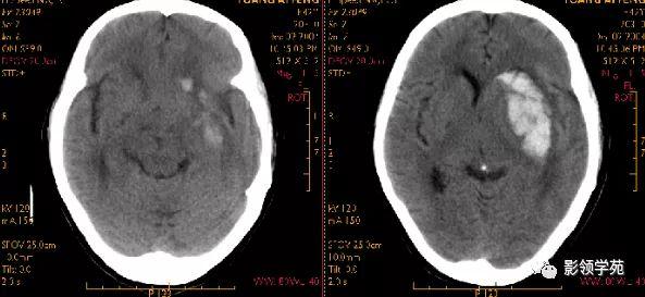 神内临床笔记54 脑出血 影像学表现