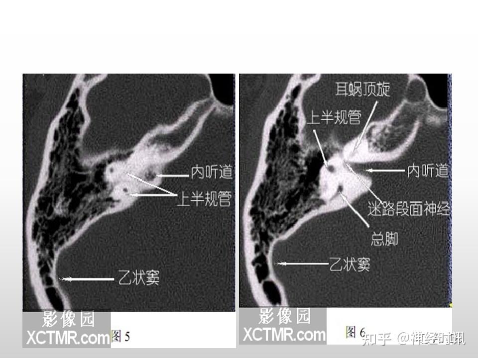 面神经解剖及相关病变 - 知乎