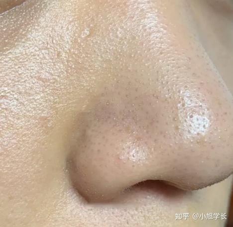 黑头是怎么来的？要怎么样才能去黑头？方法都在这里！ - 知乎