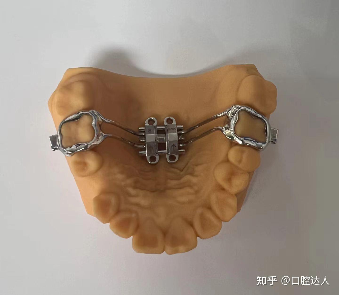 正畸大揭秘:MSE骨性扩弓 vs 传统正畸,你真的了解吗? - 知乎