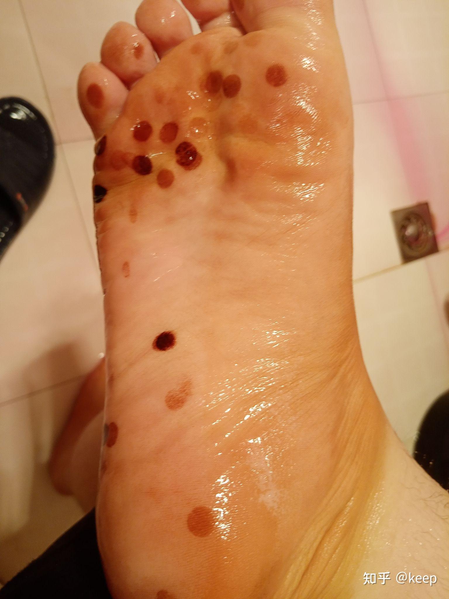 高锰酸钾泡脚留印子了怎么办