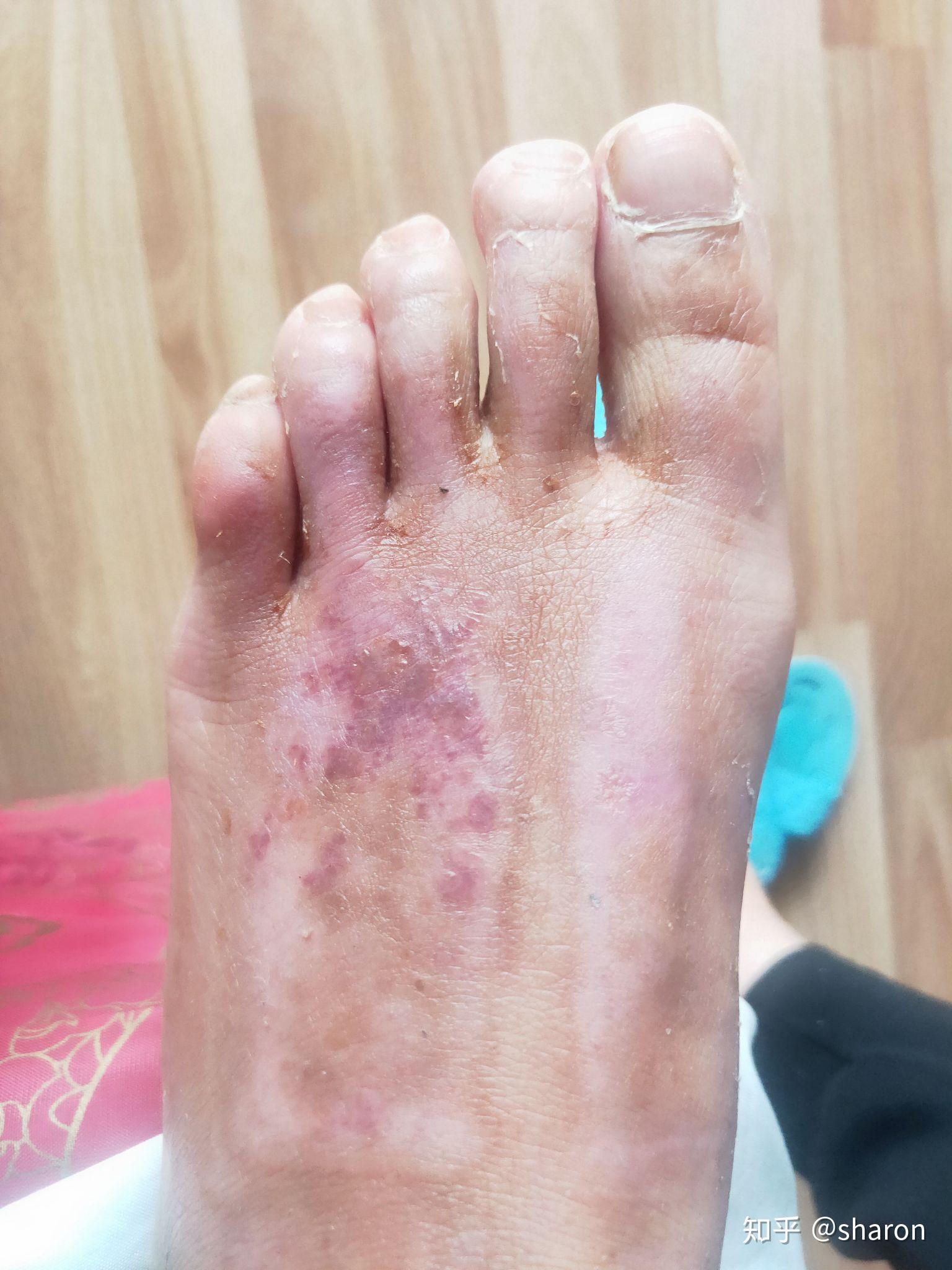 女子脚被钉子扎伤，医生用蚂蟥吸锈毒_凤凰网视频_凤凰网