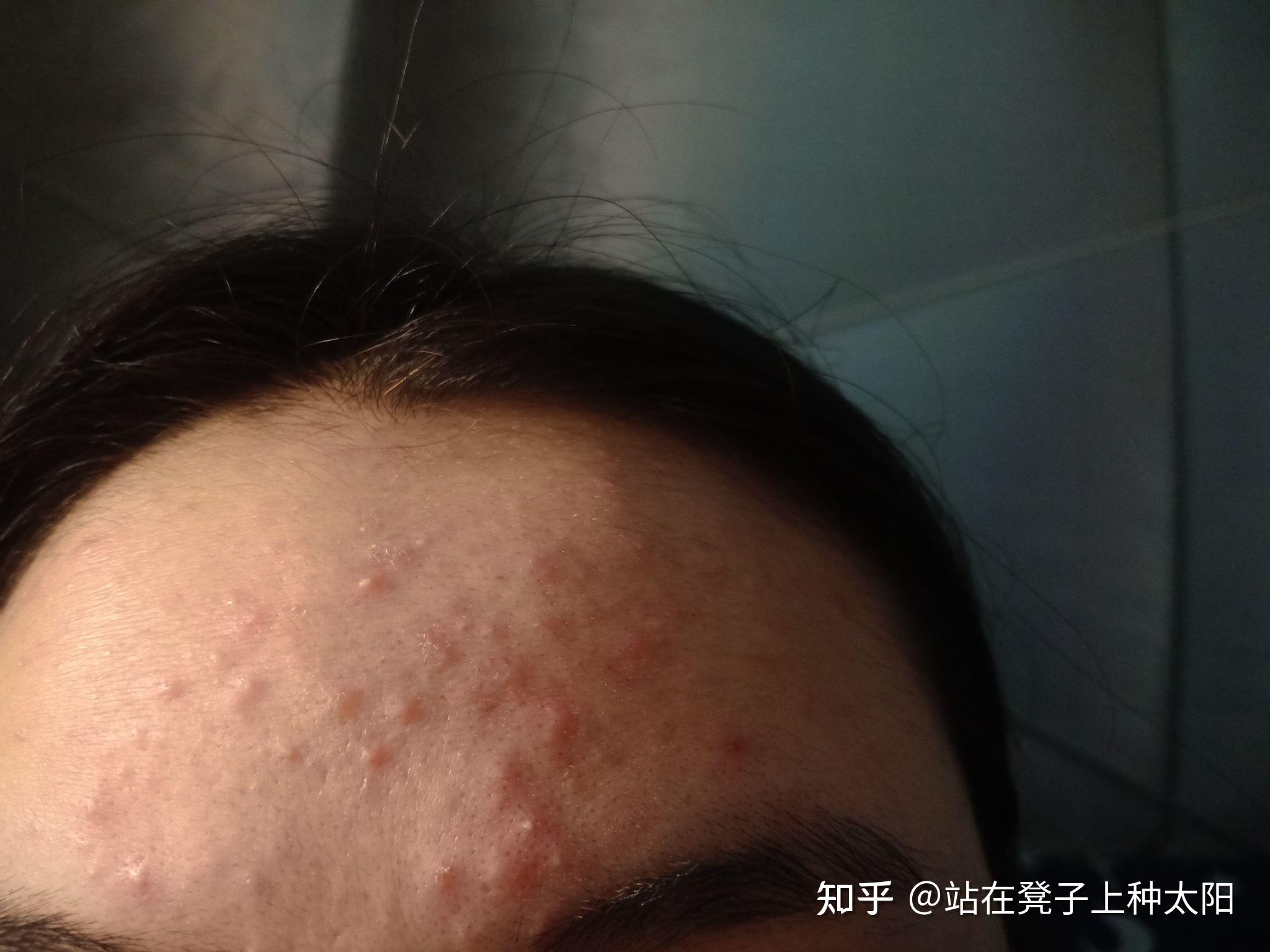 记录使用阿达帕林凝胶 - 知乎