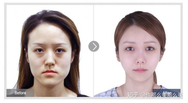 菲斯莱茵z童颜双鄂手术瘪嘴矫正