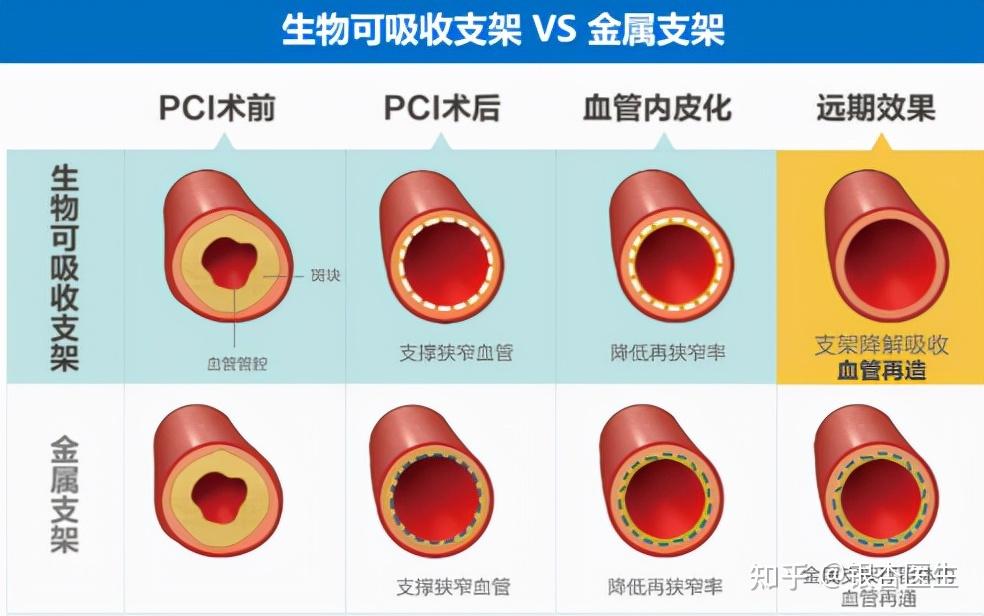 心脏可降解支架图片