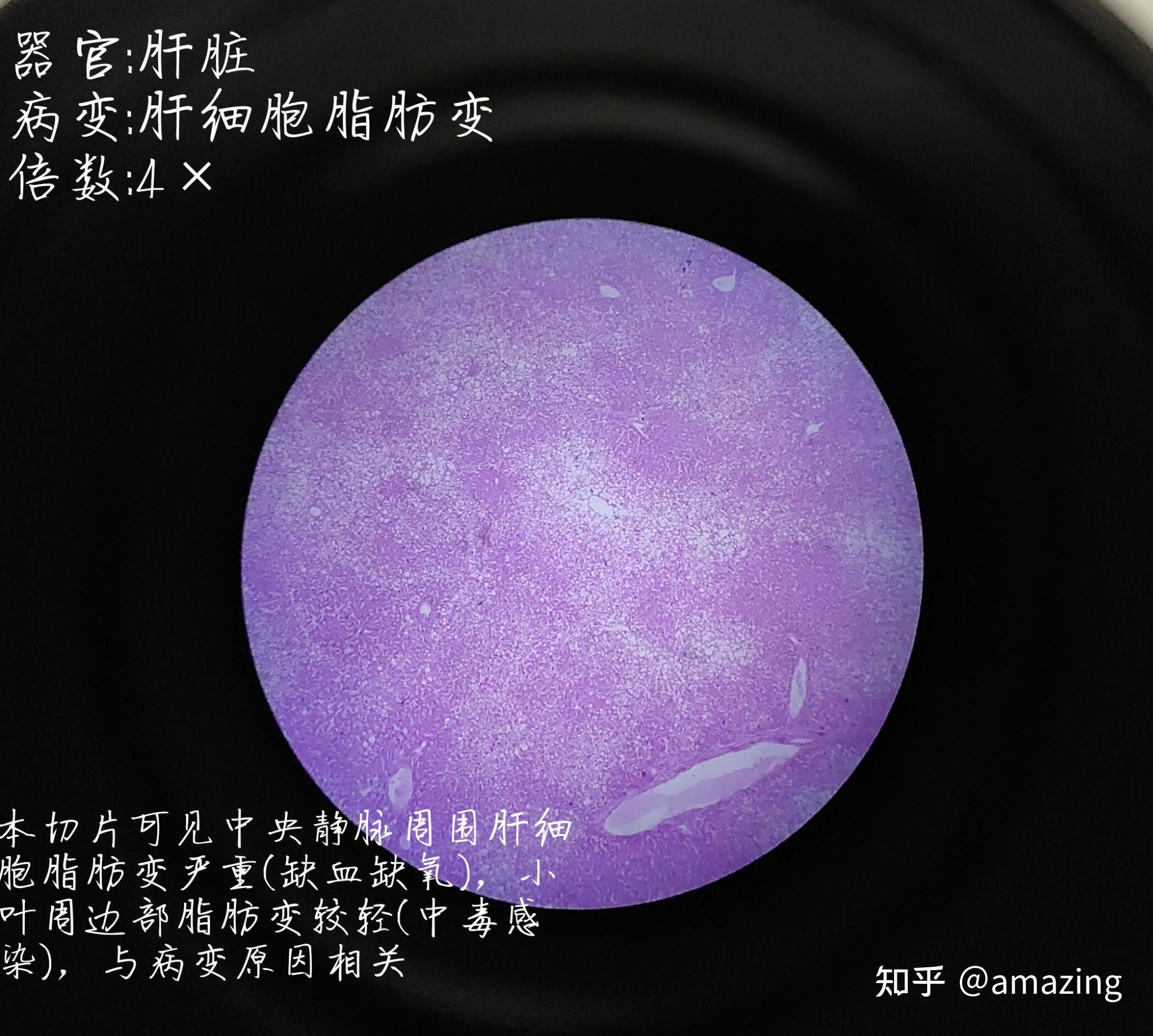 (0102)肝细胞脂肪变如图是一张40×的高倍镜图片,比较模糊,因为肝细胞