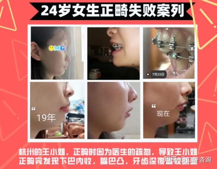 北京牙齿矫正|正畸哪个医院好？ - 知乎
