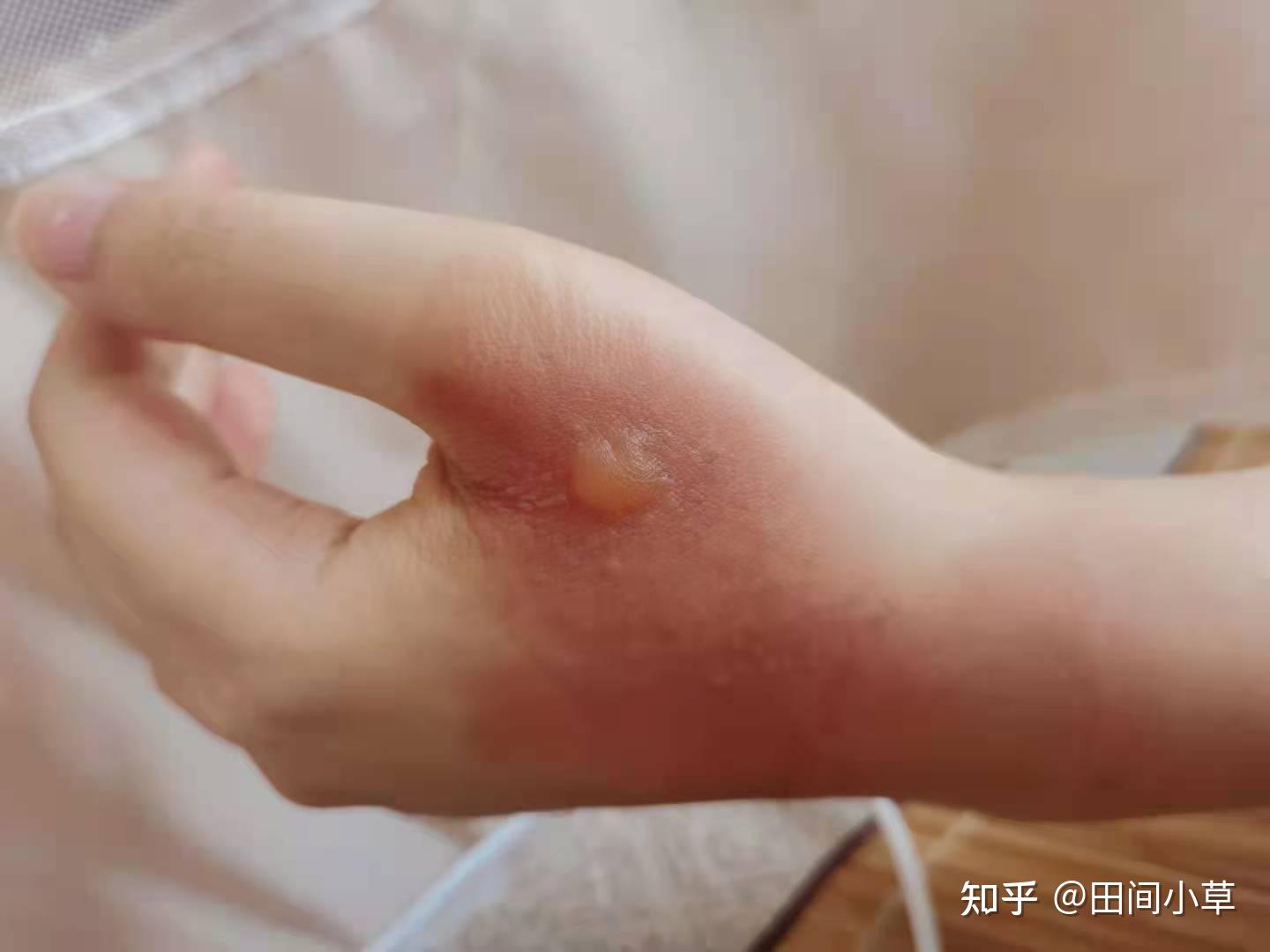 被開水燙傷的恢復記錄