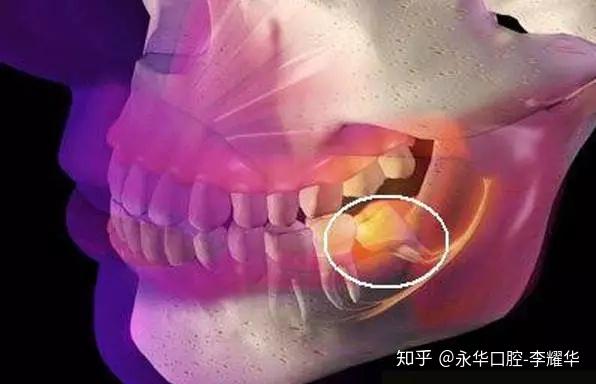 牙疼别硬撑 教你几个止疼绝招 知乎