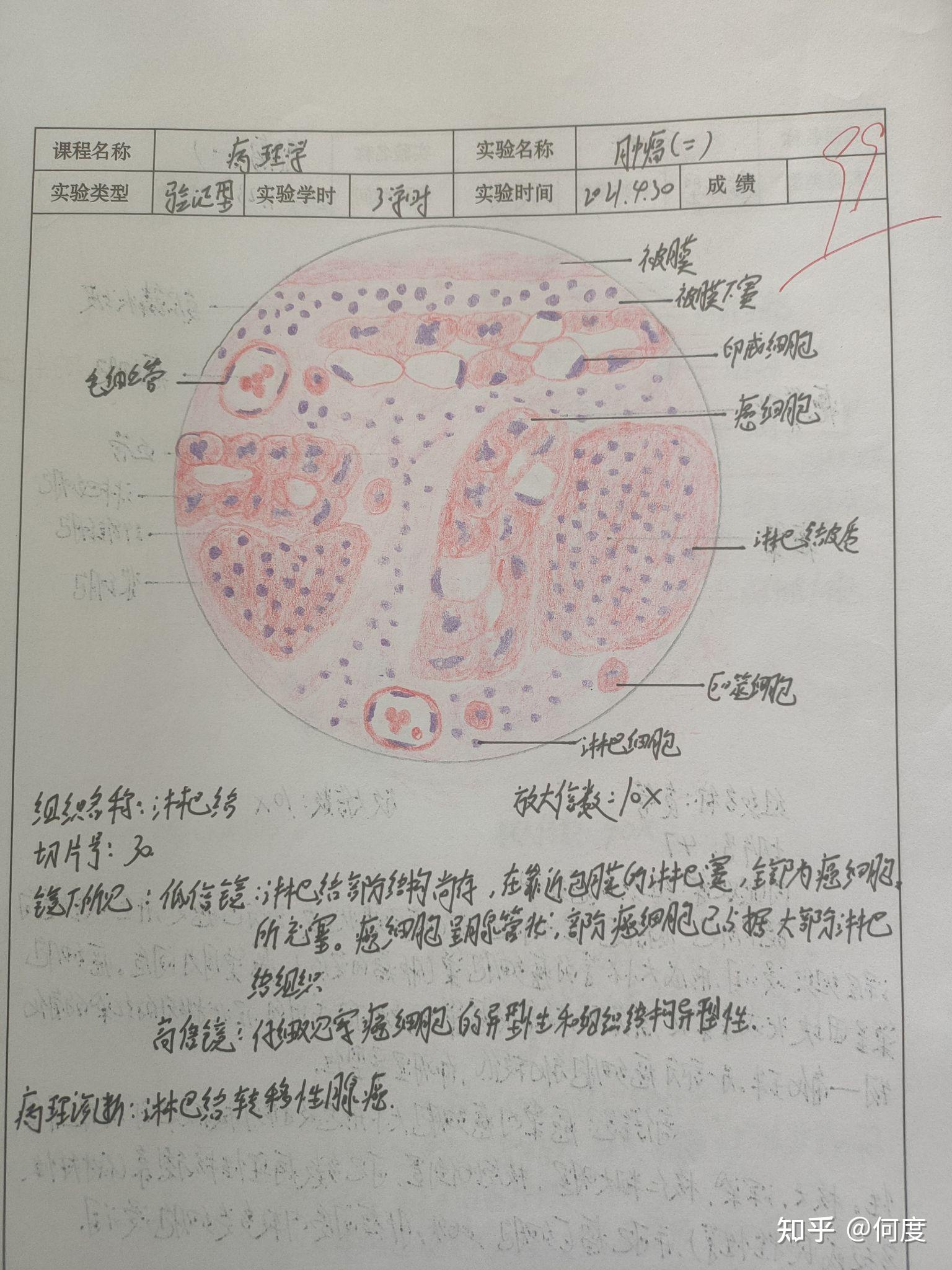 结核性肉芽肿3.急性蜂窝织炎性阑尾炎2.慢性肺淤血1.