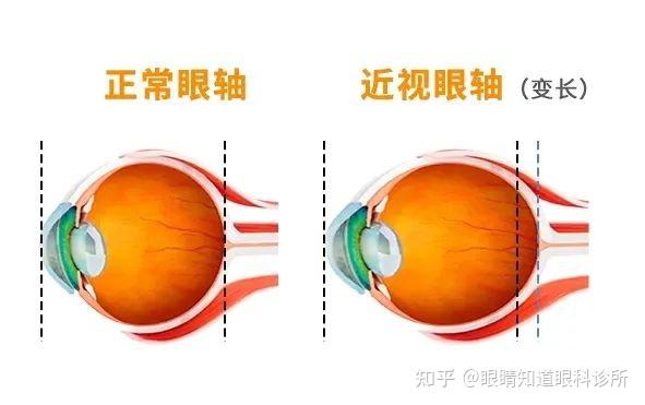 对于第一次配镜的孩子和家长们会了解到这样一个新的名词眼轴太阳那
