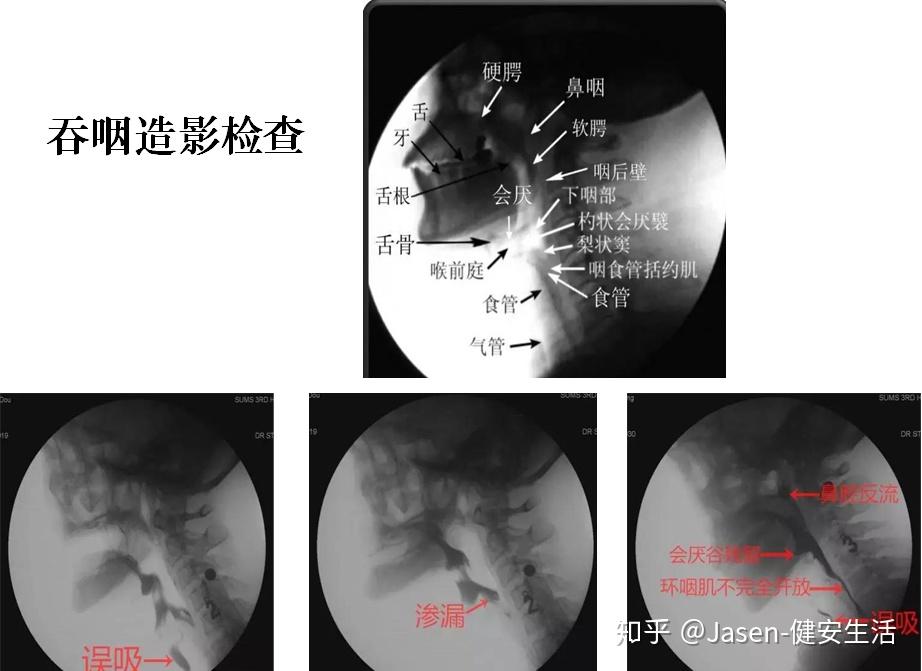 治疗师在吞咽造影检查过程中实施治疗策略,帮助病人安全且有效地经口
