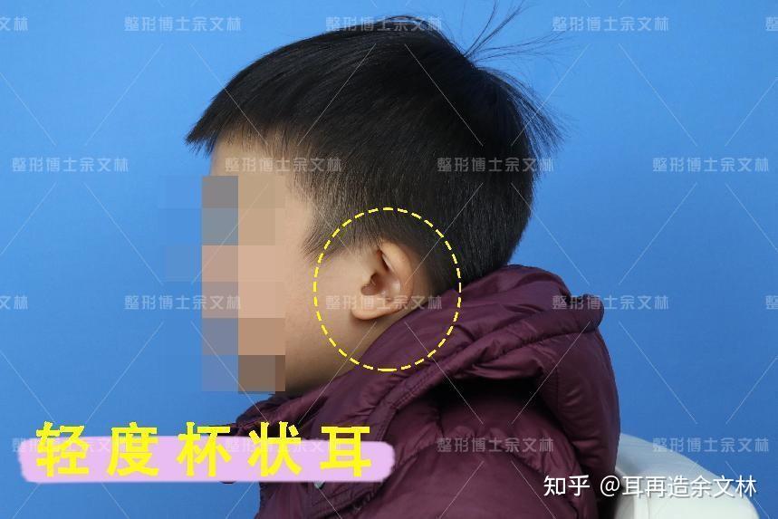 孩子轻度杯状耳要不要矫正?矫正手术有什么风险?