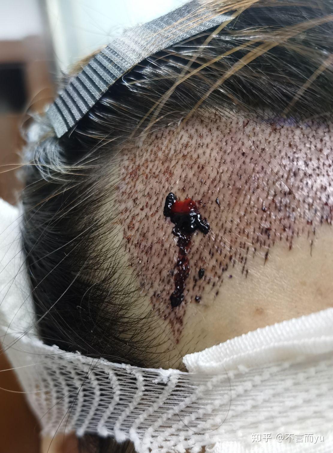 我也不敢碰,半夜起来拍了张照片是这样的……第二天后脑勺没有那么红