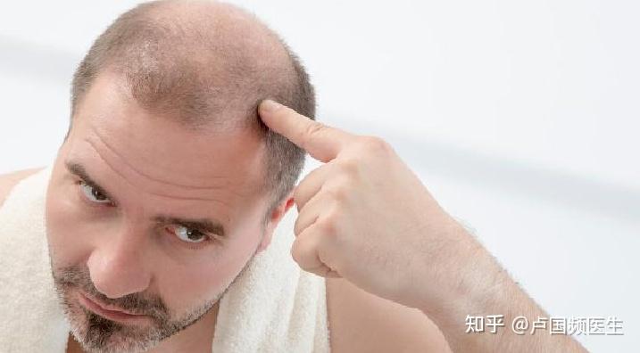 治疗脱发最怕盲目,随大流,医生:不想聪明“绝顶”,快进来看看 - 知乎