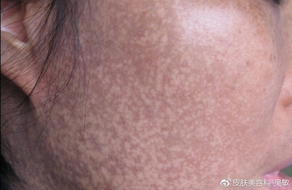 脸上的晒斑究竟是激光祛斑合适还是中医慢调更