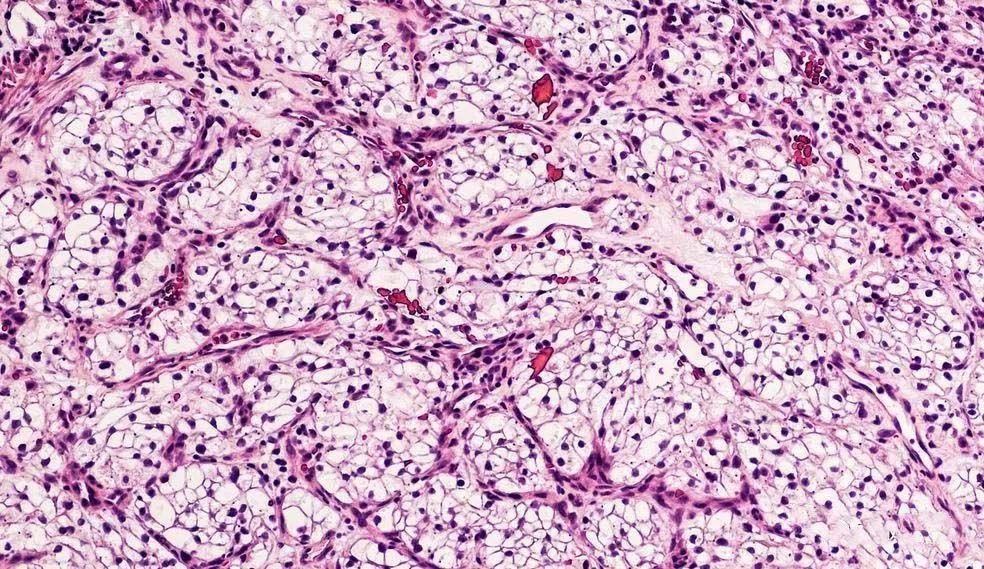 杀死末代皇帝的肾癌这些蛛丝马迹必须尽早发现