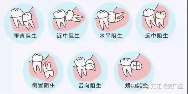 根管治疗步骤图解,让你清晰了解根管治疗整个过程! - 知乎
