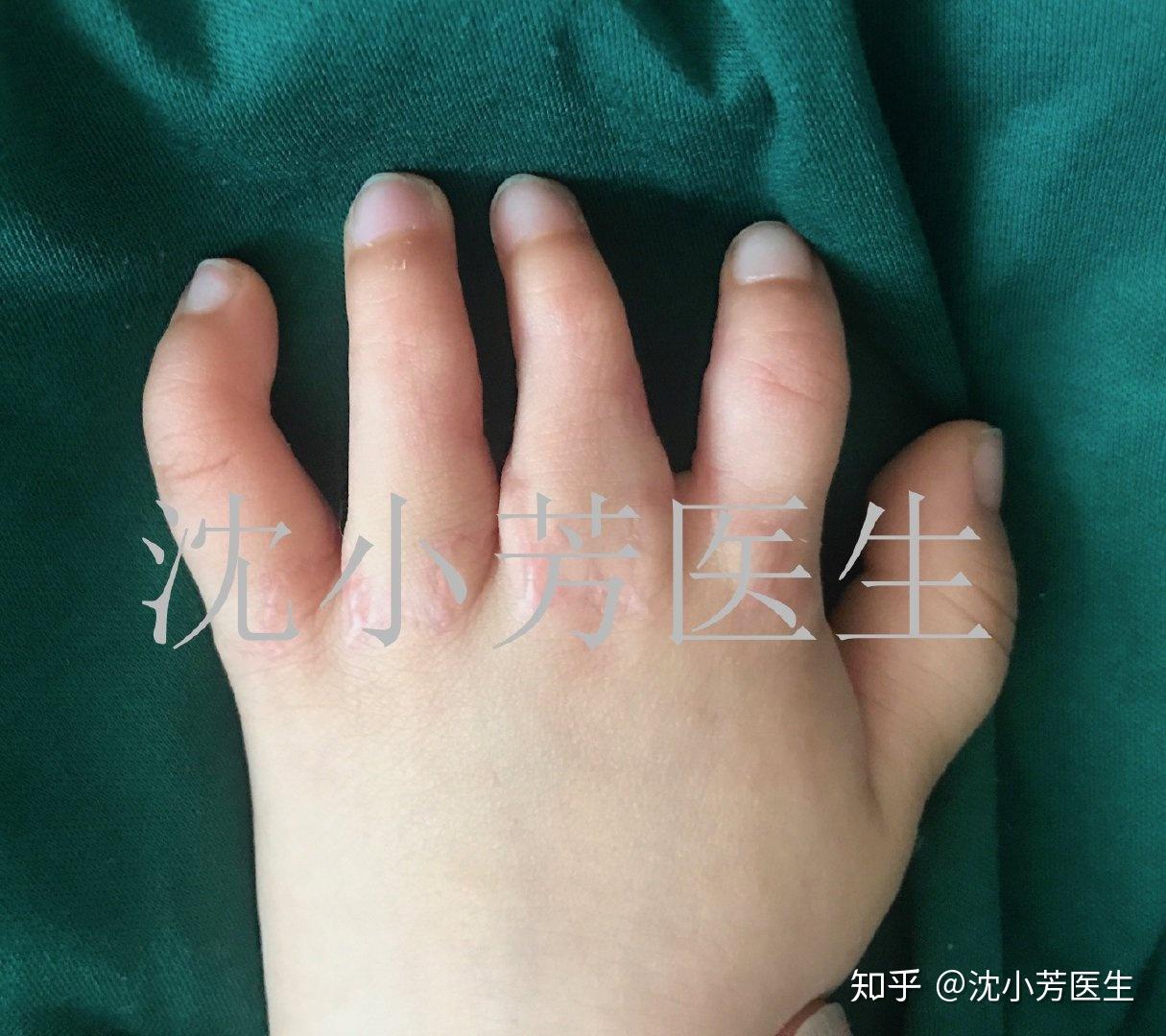 男孩手部先天性畸形，上海医生帮他“食指变拇指”_浦江头条_澎湃新闻-The Paper