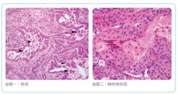 切片之後在顯微鏡下看其型態,例如大家所熟知的肺腺癌,就是因為腫瘤的