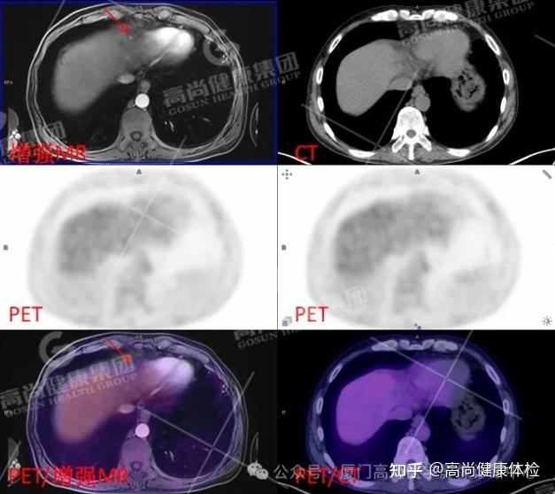 PET/CT-MR 多模态融合技术在临床中的应用病例分享（一） - 知乎