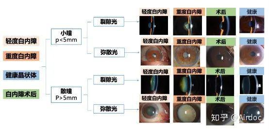 白内障cnp分级图片