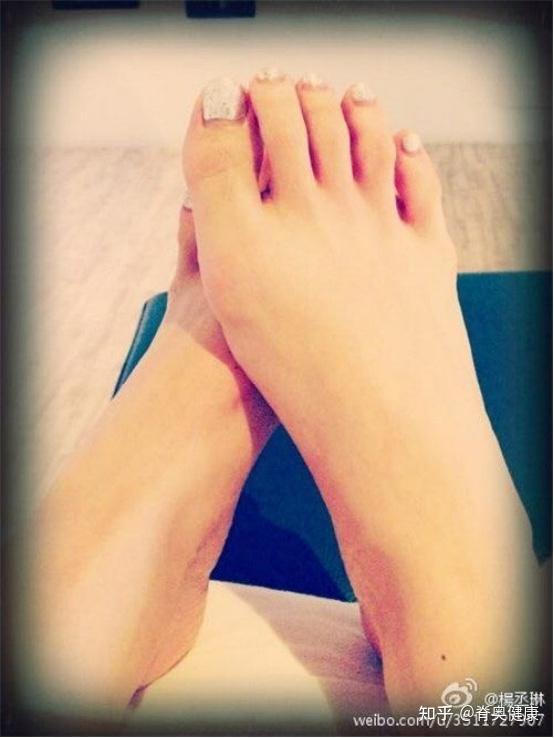 其畸形表现为脚拇趾外翻,向其它脚趾方向偏斜,而脚拇指根部的跖骨头