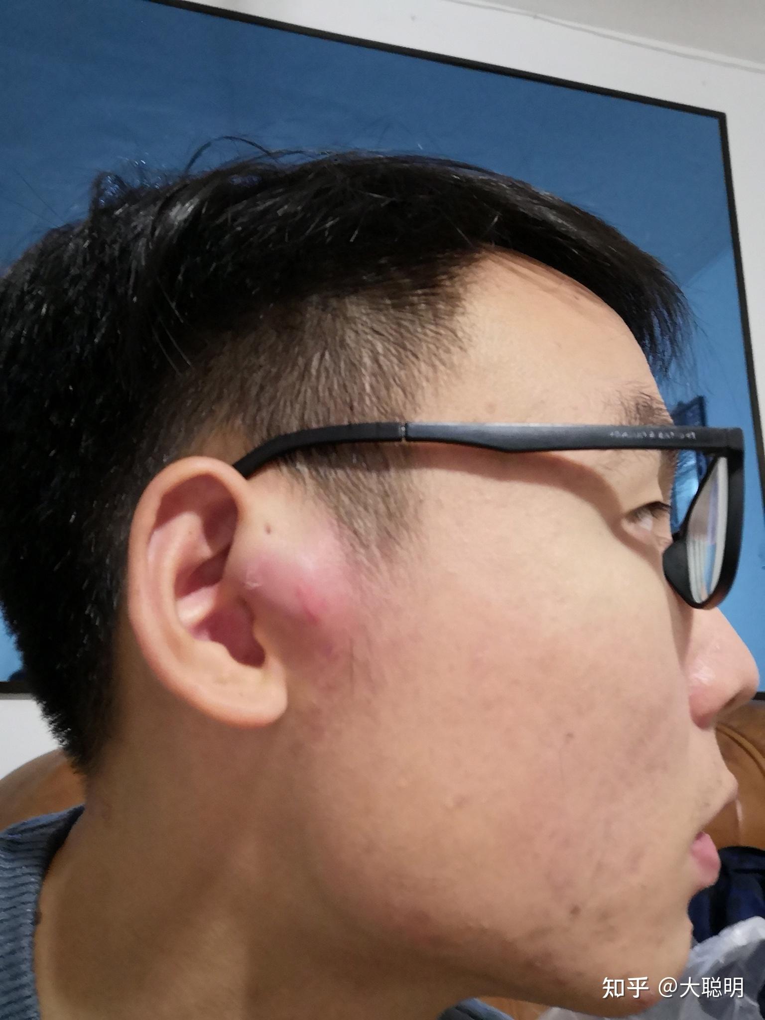 耳前瘘管疤痕图片