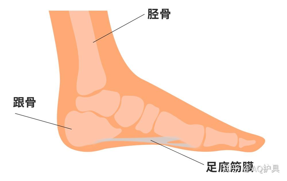 长时间跑步后足跟痛当心是足底筋膜炎