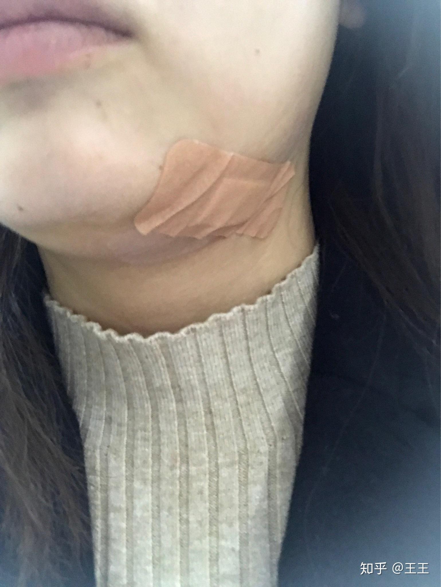 蓝痣手术切除记录 - 知乎