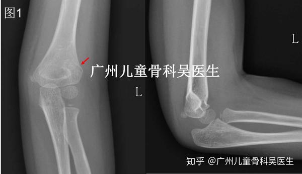 孩子意外损伤导致肱骨髁上骨折 家长该怎么办 肱骨髁上骨折功能锻炼 艾帝网