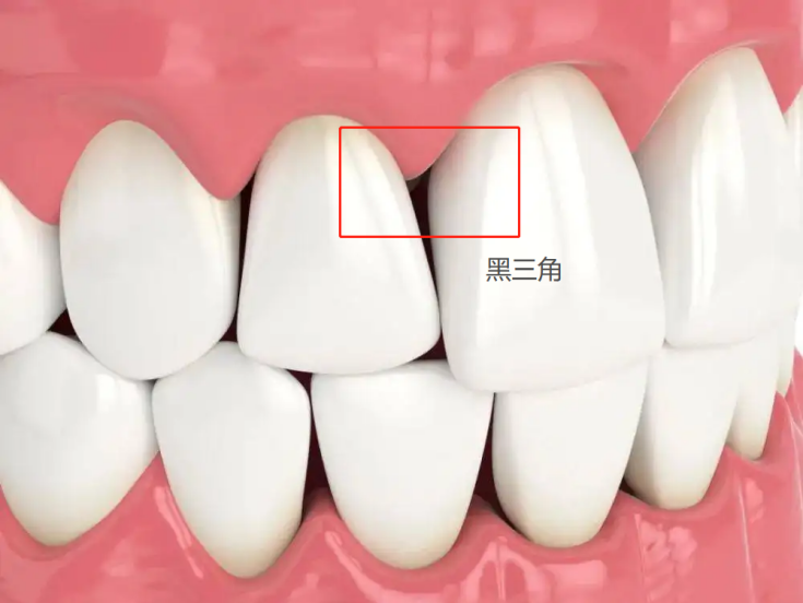 牙齿黑三角到底是什么我们该如何预防黑三角的出现