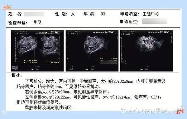 首次做试管第二个月就怀上了，她是怎么做到的？ - 知乎