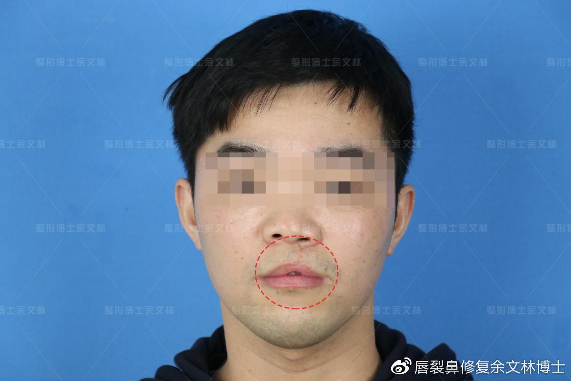 记录️篇||广州做的唇裂二期修复，术后到半年后记录！ - 知乎