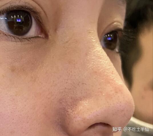 之前我那一粒粒像似油脂的物体,其实就是黑头堵住毛孔后毛囊里分泌