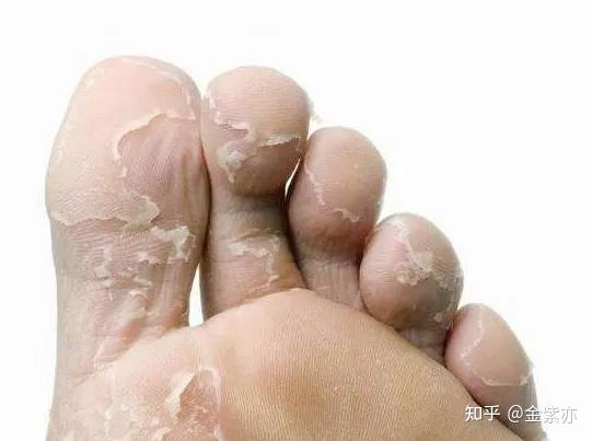 得了难以启齿的香港脚该如何是好