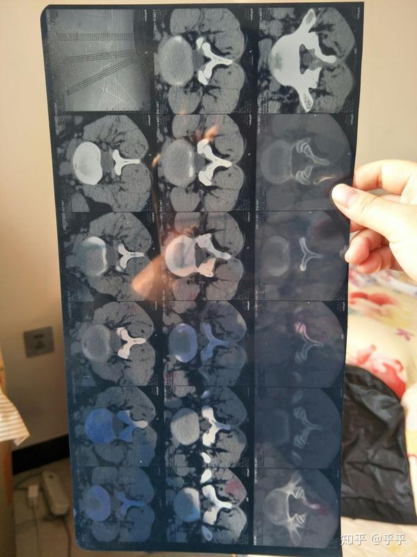 致密性髂骨炎会好吗?下面我描述了时长,位置,起因等?