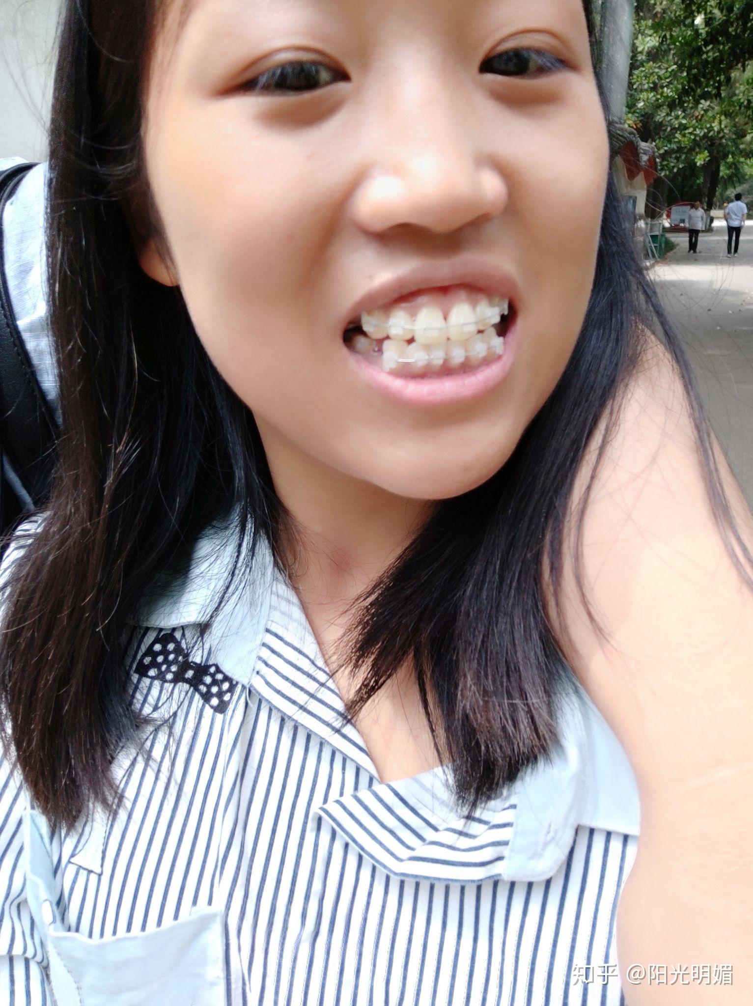 大龄小姐姐,漫漫整牙路