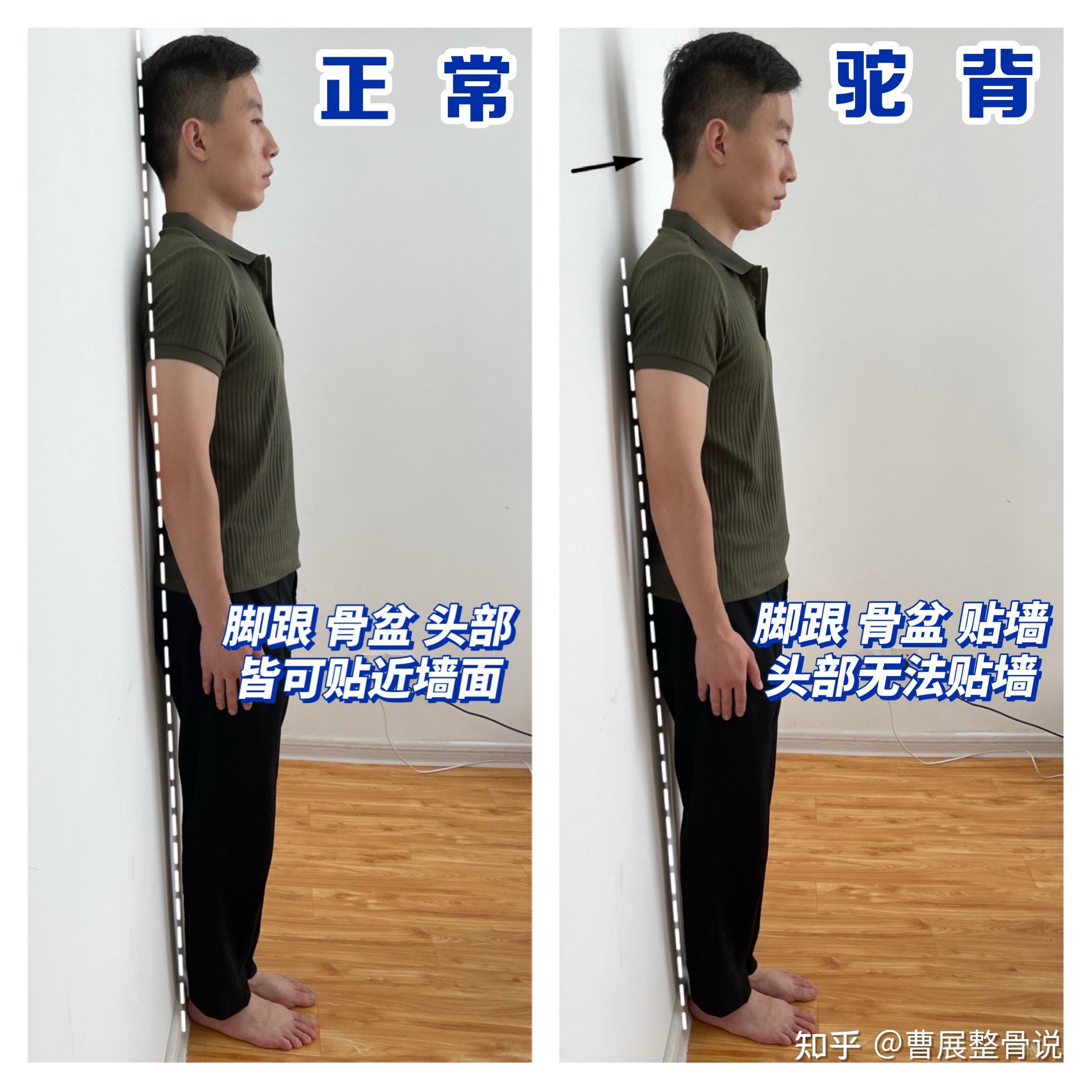 怎么矫正含胸驼背 - 知乎