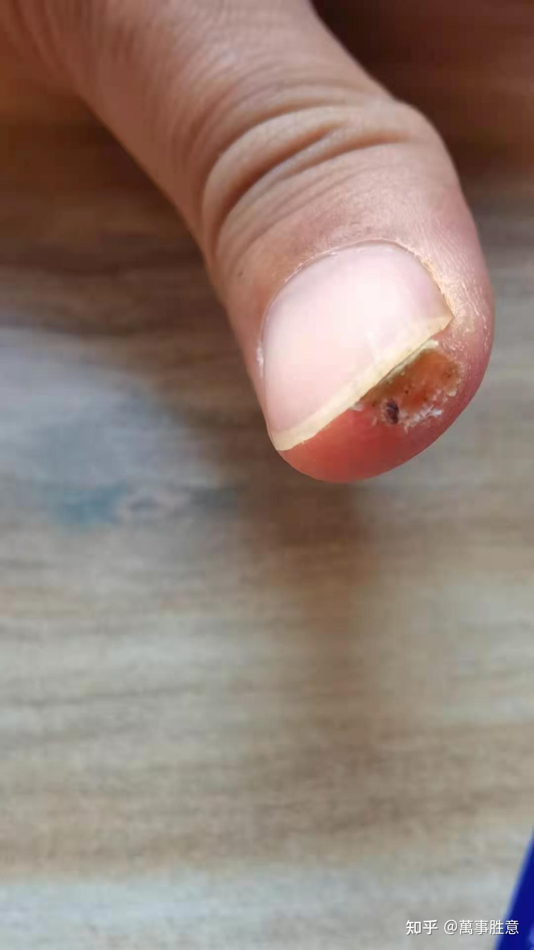 感谢将军8年的甲周疣终于好了