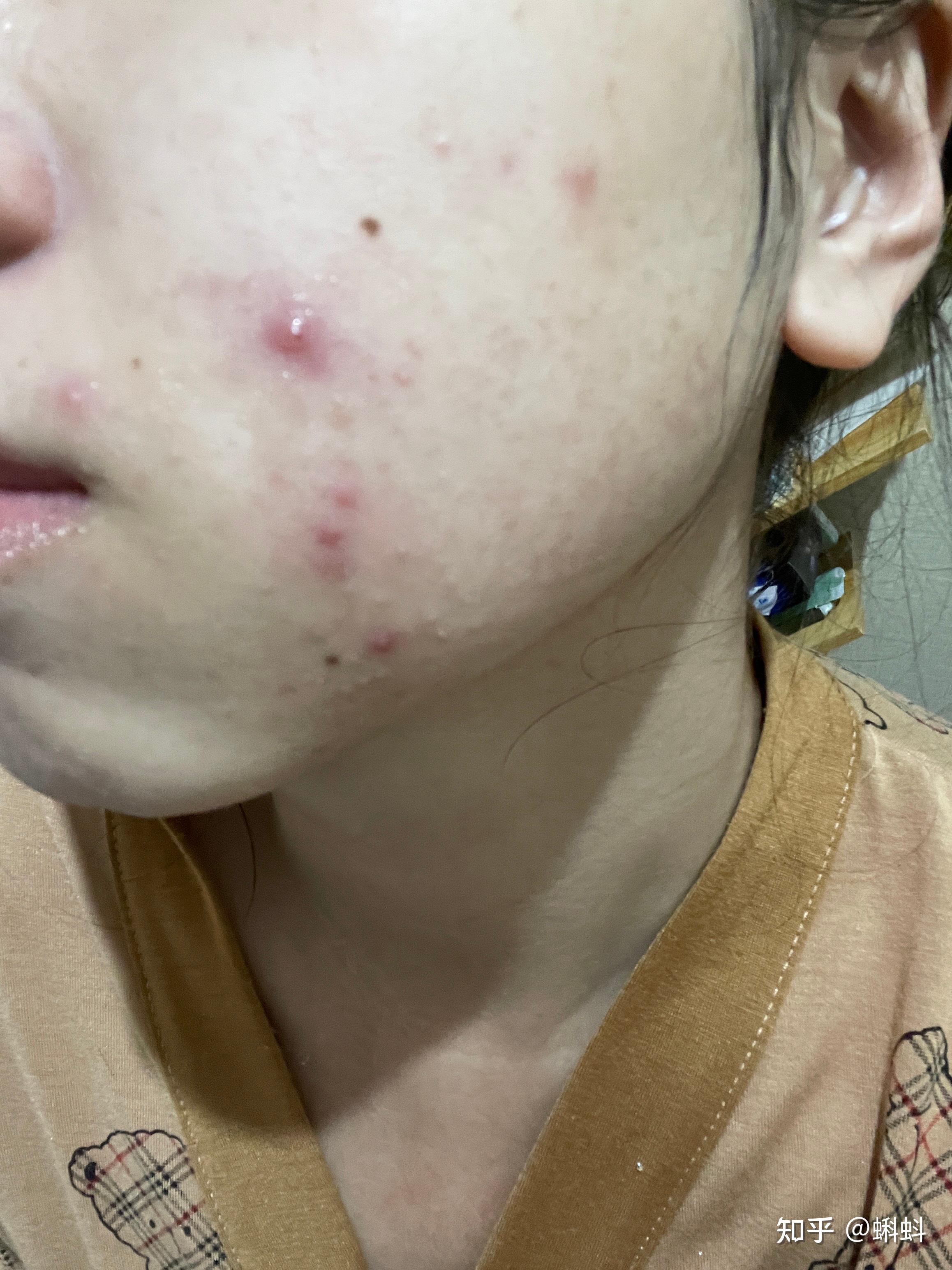 摄于7.8号晚22:00,呜呜,手贱挤了脸颊的痘痘,现在又红又肿,我错了!